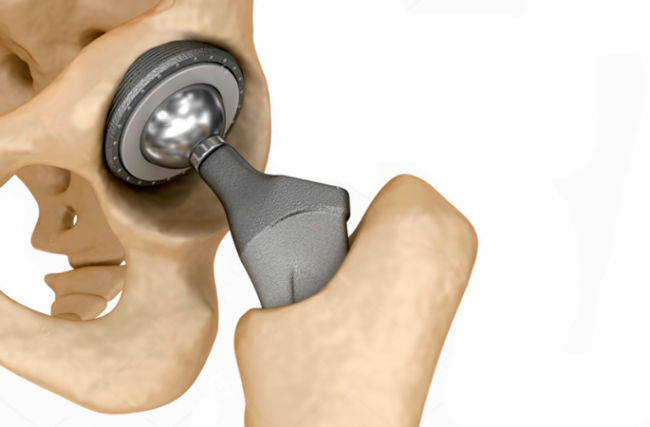 O que é a cirurgia de Artroplastia Total do Quadril? (Prótese de Quadril)