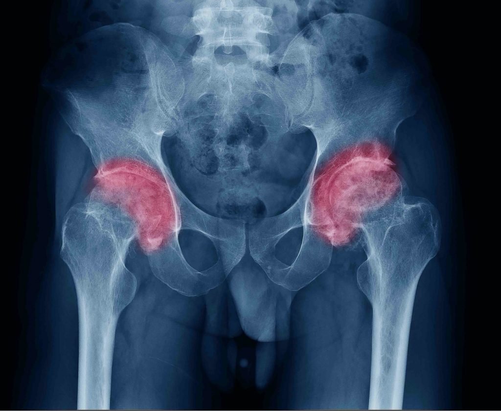 Artrita reumatoida – ce este si cum poate fi prevenita