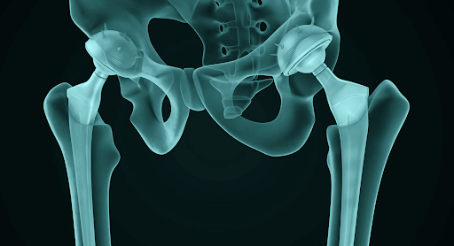 Quais cuidados tomar após a artroplastia de quadril? | Blog | Dr. Daniel  Rebolledo