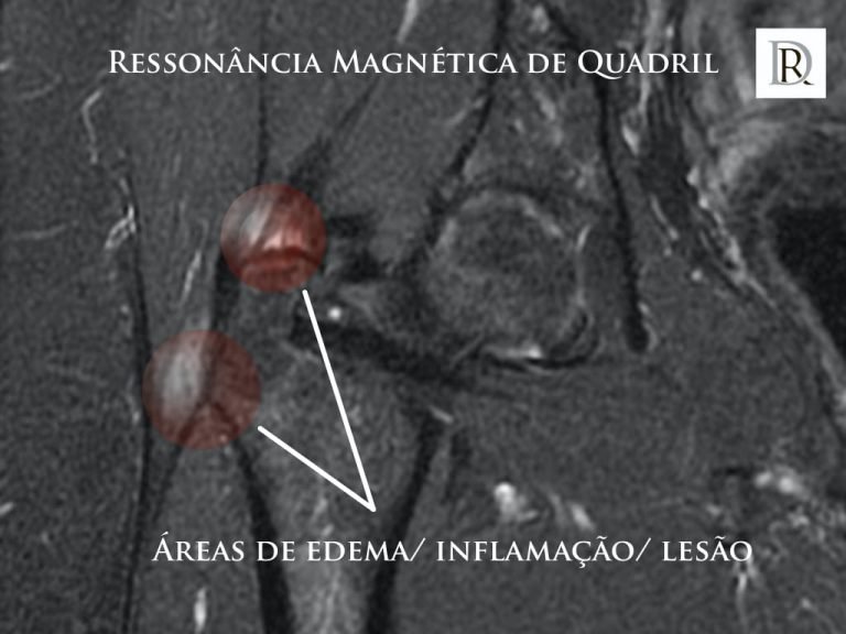 A ressonância magnética é o melhor exame de imagem na avaliação da bursite no quadril