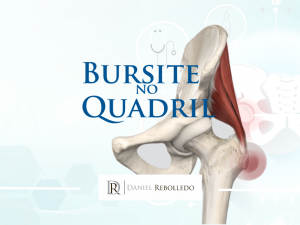 A Bursite no Quadril ou bursite trocantérica é uma das principais causas de dor no quadril