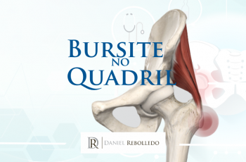 Bursite no Quadril ou Bursite Trocantérica