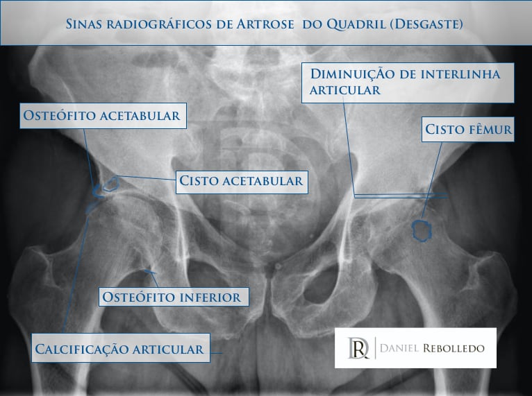 Radiografia de Bacia mostrando o quadro de artrose de quadril (desgaste)