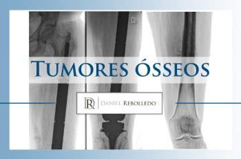 Tumor ósseo: Sintomas ao Tratamento