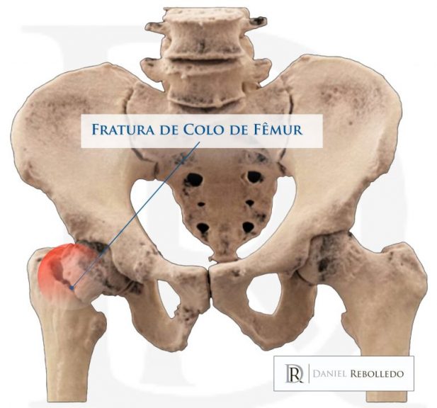 A Fratura de colo de fêmur é uma das indicações de prótese de quadril em adultos