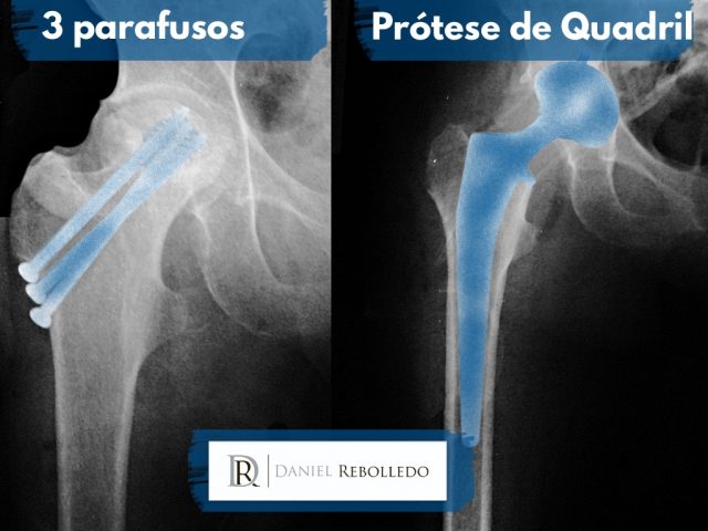 Fratura de femur parafusos e protese