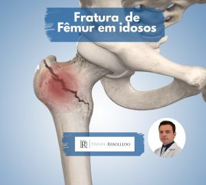 Fratura de femur em idosos Titulo