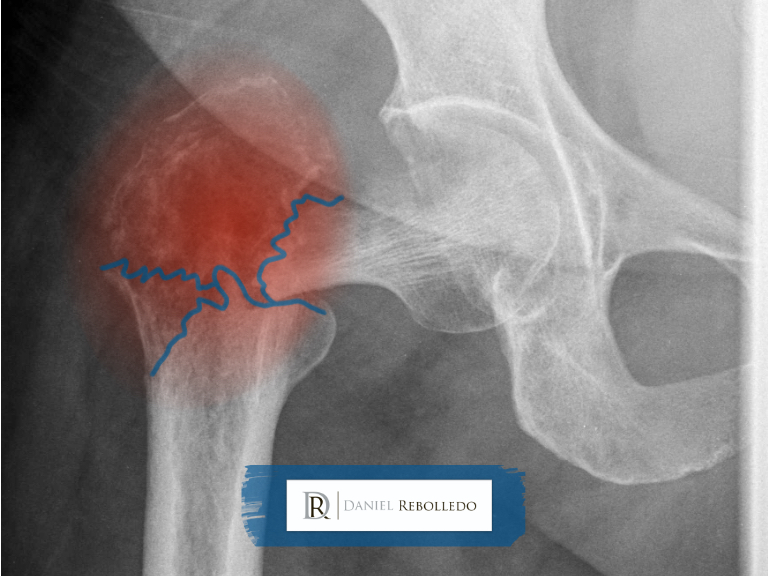 Fratura patologica femur