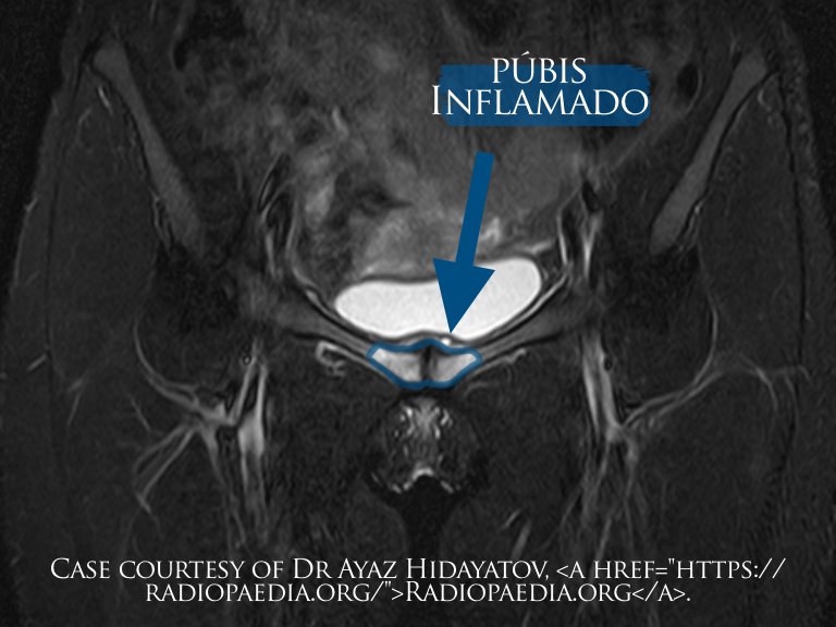 Ressonância Magnética mostrando inflamação do púbis