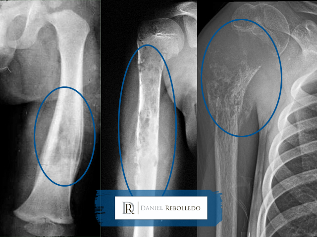 Sarcoma de Ewing fotos 