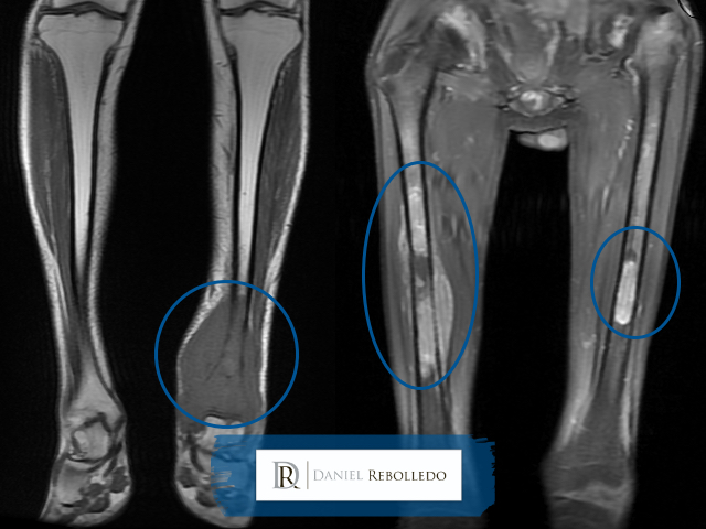 Sarcoma de Ewing fotos