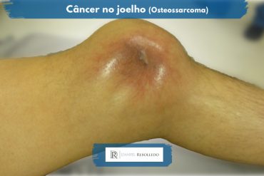 Cancer de joelho osteossaroma