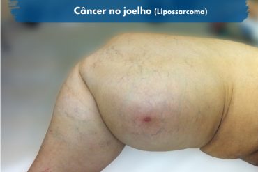 Sarcoma de joelho