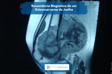 Ressonância Magnética de um câncer de joelho (osteossrcoma)