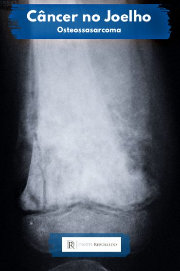 Radiografia de câncer de joelho (osteossarcoma)