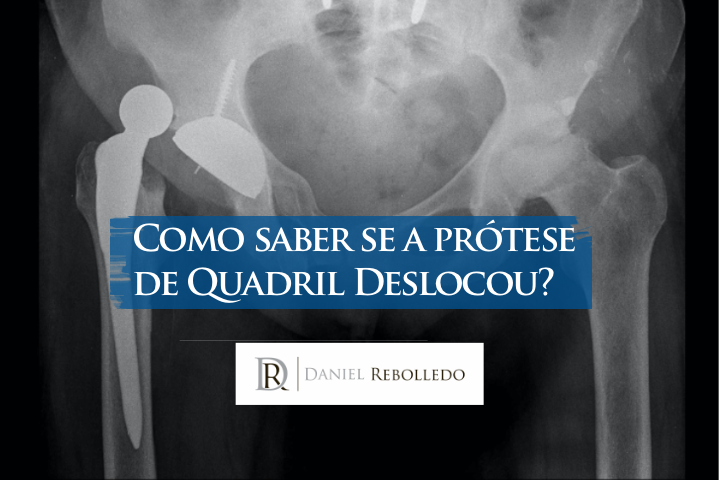 Como saber se a protese de quadril deslocou?