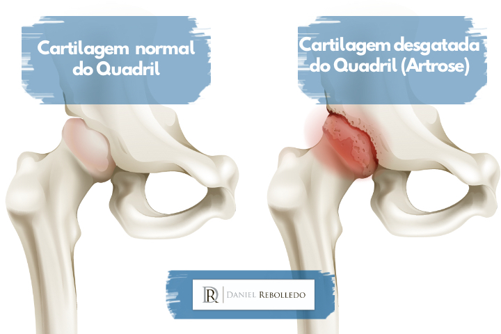 artrose no quadril