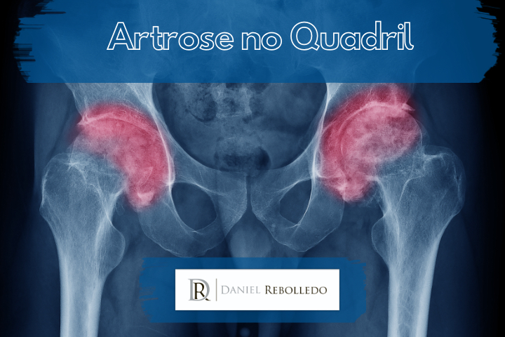 Radiografia de artrose de quadril bilateral