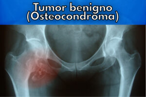 tumor benigno no quadril