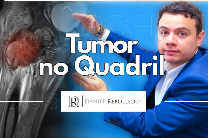 Tumor no Quadril. O que pode ser?