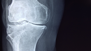 Consulta para tumor ósseo com ortopedista