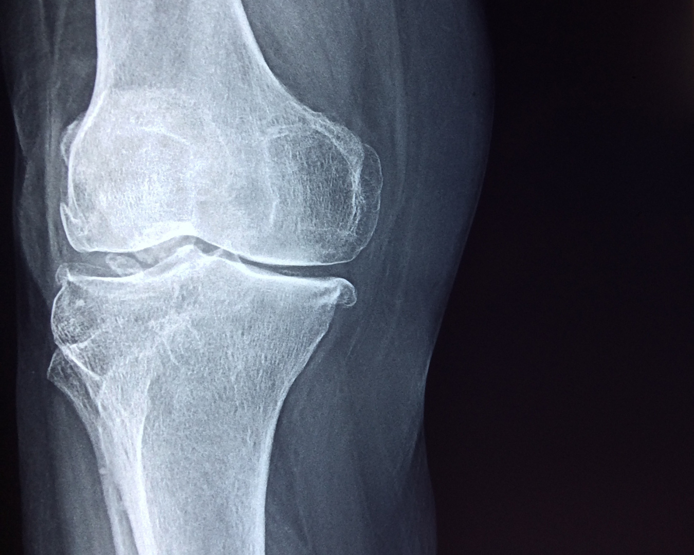 Consulta para tratamento de Tumor Ósseo: Quando Procurar Avaliação Especializada