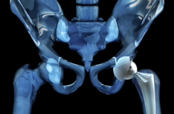 Cirurgia de Prótese de Quadril: quando pode ser considerada na avaliação ortopédica