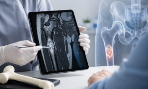 Médico avaliando uma ressonância magnética com alteração óssea durante consulta