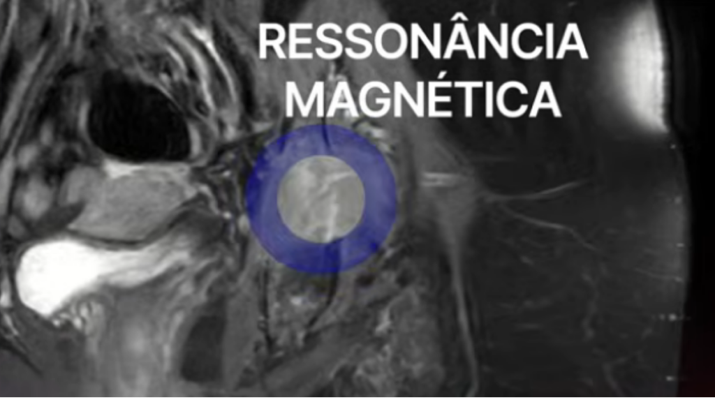 Ressonância magnética (RM) no quadril e fêmur