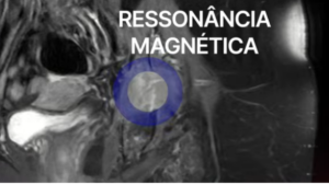 Ressonância magnética (RM) no quadril e fêmur